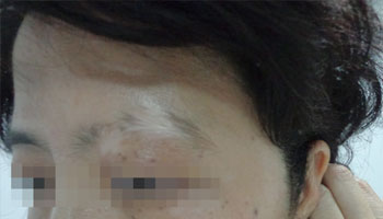 眼皮上和眼睛周围的白斑是什么