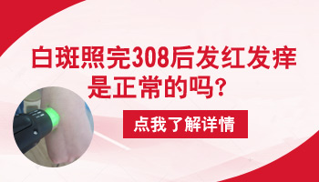 儿童白癜风做308后碰水了有点发红怎么办