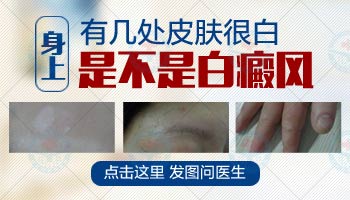 3岁孩子身上白一块会不会是长了白癜风