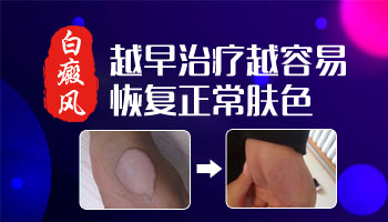 大腿外侧有白斑如何判断是不是白癜风