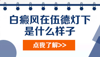 伍德氏灯能检查怎么确定是白癜风