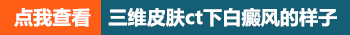 伍德氏灯检查白癜风是什么颜色