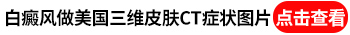 面部不明显的白斑会是白癜风吗