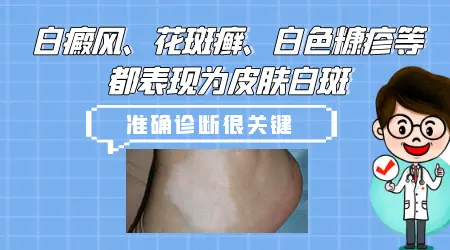 白斑皮肤病图 长白斑怎么回事