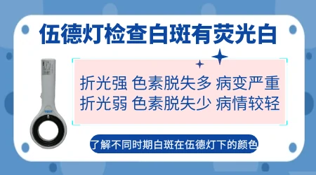 白癜风在伍德灯下什么样子