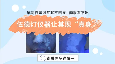 肚子白斑不疼不痒是什么