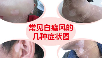 小孩身上长白斑症状图