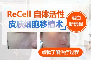 河北远大白癜风医院有recell自体黑色素细胞技术吗