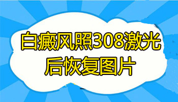 308激光照白癜风是按照什么标准收费的