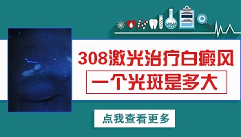 一个光斑大概有多大面积 光疗能治好白癜风吗