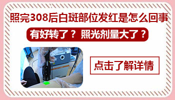 白癜风照308激光一周还是红怎么回事