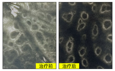 白癜风照308一直不红还需要再照吗