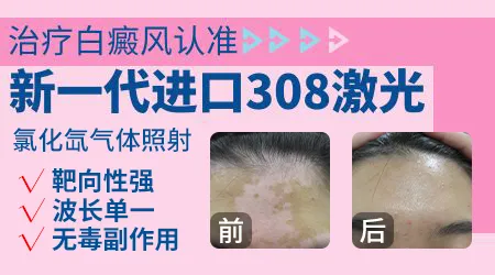 308激光治疗白斑价格治疗