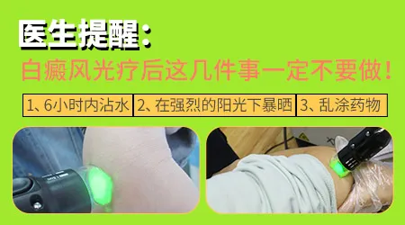 晕痣型白斑可以照光治疗吗