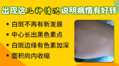 308准分子激光治疗每次间隔几个小时