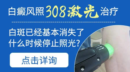 308激光照白癜风照到什么程度停止