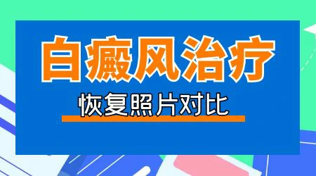 网购买的308照射白癜风靠谱吗