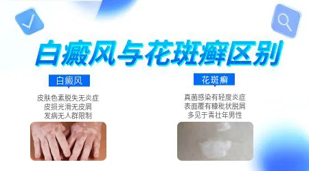 汗斑和白癜风早期图片对比