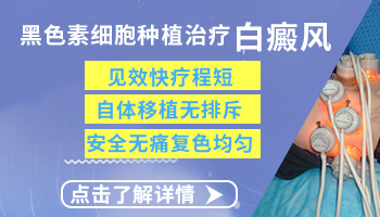 黏膜上的白癜风如何治疗效果好