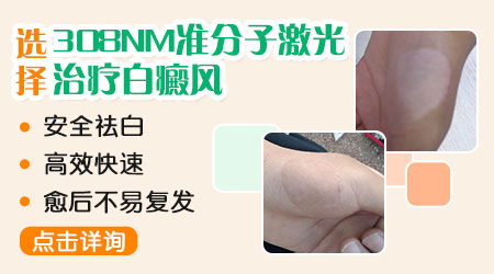 308准分子激光治疗仪有家用版吗