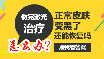 白癜风光疗后正常皮肤被照黑了怎么办