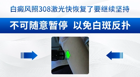 308激光可以治疗婴儿白癜风吗