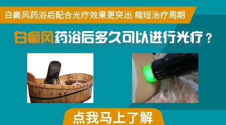 白癜风照光紫外线几天一次合适