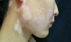 青少年白癜风早期症状有哪些