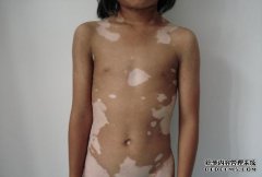 孩子腰部白癜风的危害都有什么?