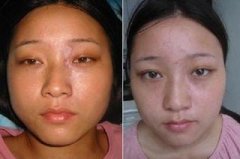 脸上的白癜风怎样才能治好?