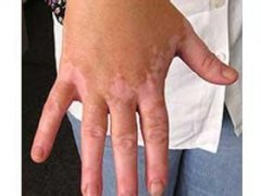 手指上出现小白点是不是就是白癜风呢?