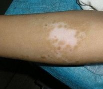 双臂白癜风治不好的原因有哪些