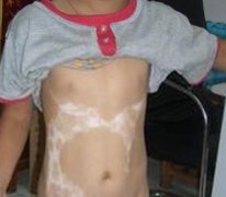 胸部白癜风是否影响患者正常生活