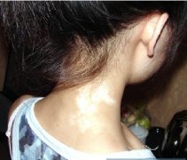 脖子上的白点点是白癜风吗