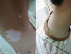 青少年白癜风治疗有哪些优势