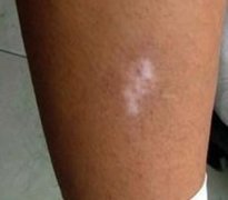 外伤性白癜风的发病受哪些因素的影响