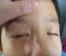 青少年白癜风早期有什么症状
