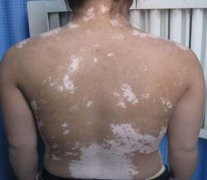 散发型白癜风有哪些病因呢