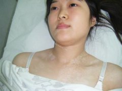 胸部出现白斑的护理方法有哪些?