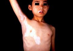 胸部白癜风症状是怎样的