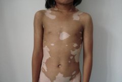 怎样治疗胸部白癜风效果好?