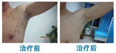 彻底治好白癜风可能吗
