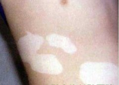 散发型白癜风该如何治疗呢