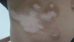 外伤型白癜风植皮手术治疗效果好吗