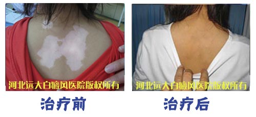 生完孩子哺乳期治疗白斑好康复吗