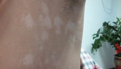 胸部白癜风扩散对患者有什么危害