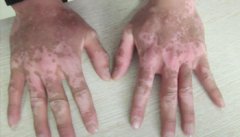 泛发型的白癜风发病有哪些特点