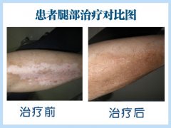 生活中如何预防白癜风的发生