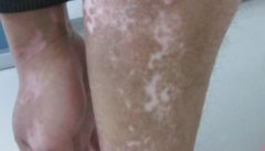 节段型白癜风用308激光治疗怎么样