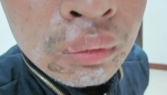 人们要如何预防白癜风白斑发病